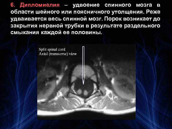 6. Дипломиелия – удвоение спинного мозга в области шейного или поясничного утолщения. Реже удваивается