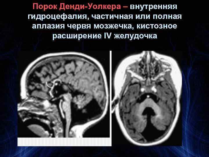 Порок Денди-Уолкера – внутренняя гидроцефалия, частичная или полная аплазия червя мозжечка, кистозное расширение IV