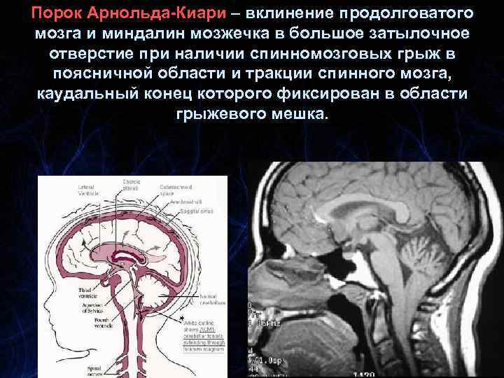 Порок Арнольда-Киари – вклинение продолговатого мозга и миндалин мозжечка в большое затылочное отверстие при