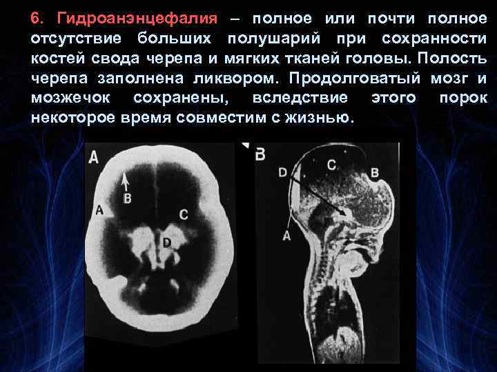 6. Гидроанэнцефалия – полное или почти полное отсутствие больших полушарий при сохранности костей свода