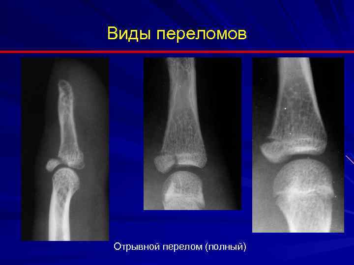 Отрывной перелом