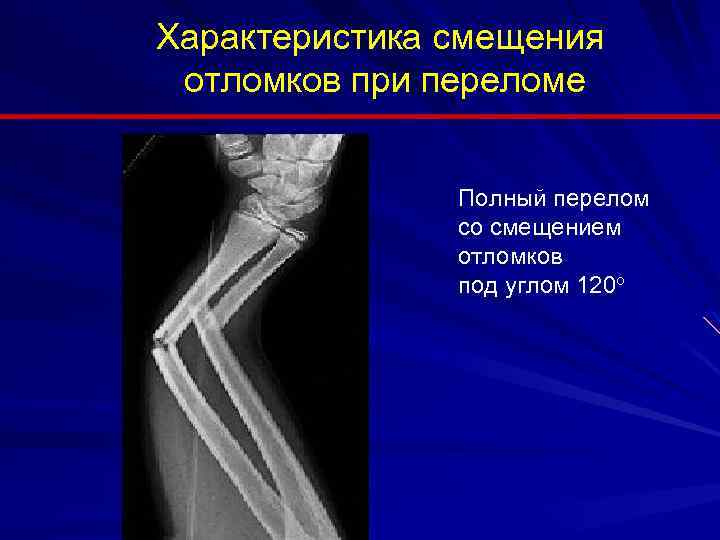 Характеристика смещения отломков при переломе Полный перелом со смещением отломков под углом 120 о