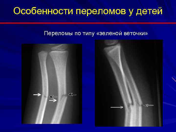 Особенности переломов у детей Переломы по типу «зеленой веточки» 