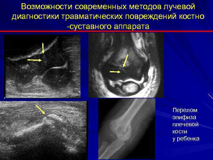 Возможности современных методов лучевой диагностики травматических повреждений костно -суставного аппарата Перелом эпифиза плечевой кости