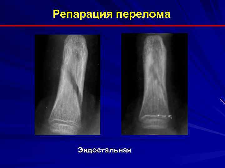 Репарация перелома Эндостальная 