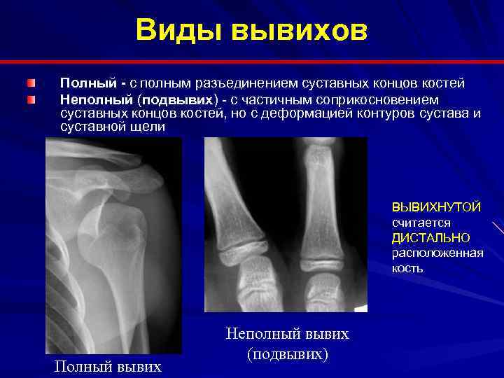 Смещение суставных концов костей относительно друг друга. Подвывих коленного сустава рентген.