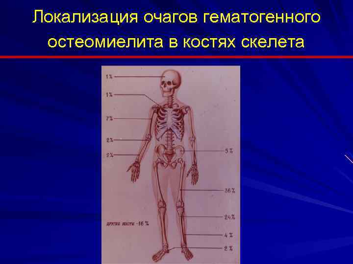 Локализация очагов гематогенного остеомиелита в костях скелета 