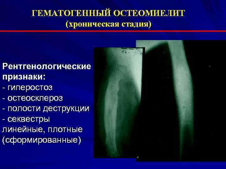 Остеосклероз симптомы