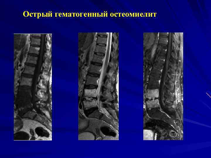 Рентгенодиагностика остеомиелита презентация