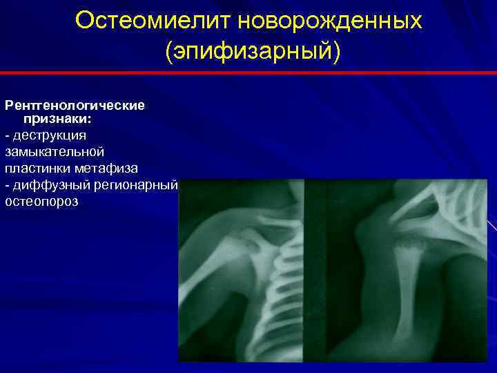 Артрит презентация хирургия