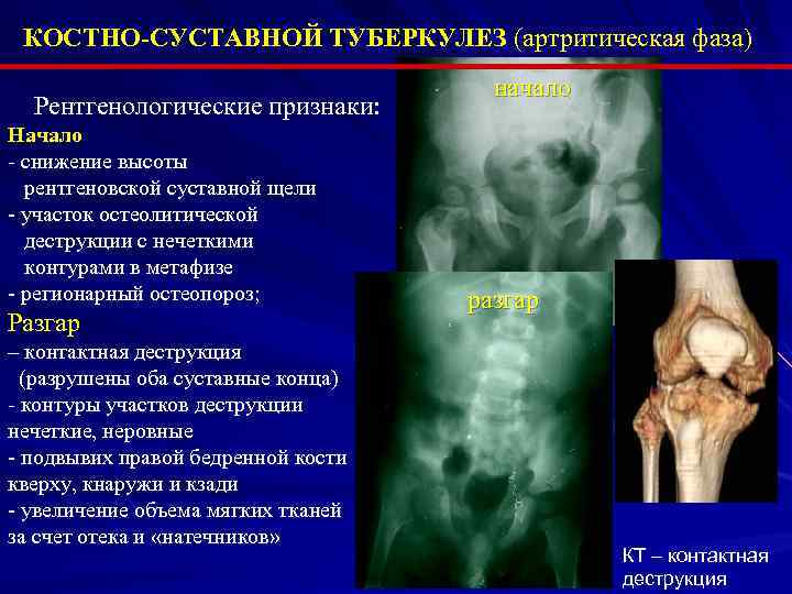 КОСТНО-СУСТАВНОЙ ТУБЕРКУЛЕЗ (артритическая фаза) Рентгенологические признаки: Начало - снижение высоты рентгеновской суставной щели -