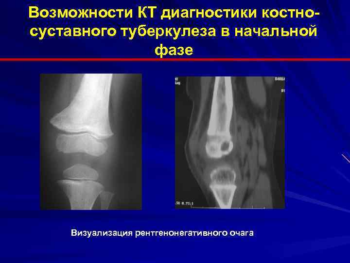 Возможности КТ диагностики костносуставного туберкулеза в начальной фазе Визуализация рентгенонегативного очага 