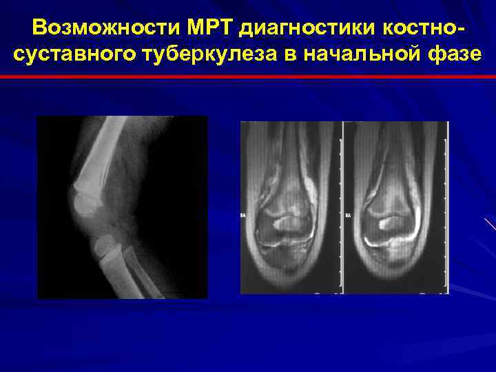 Возможности МРТ диагностики костносуставного туберкулеза в начальной фазе 