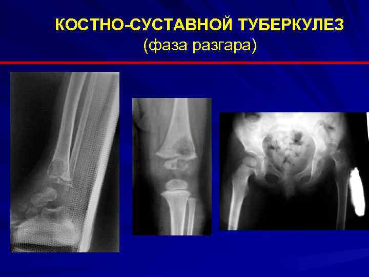 Туберкулез костей и суставов фото