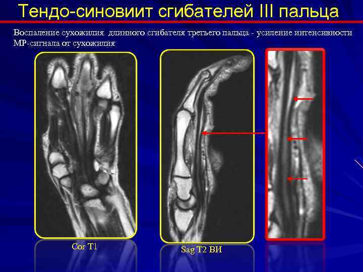 Тендо-синовиит сгибателей III пальца Воспаление сухожилия длинного сгибателя третьего пальца - усиление интенсивности МР-сигнала