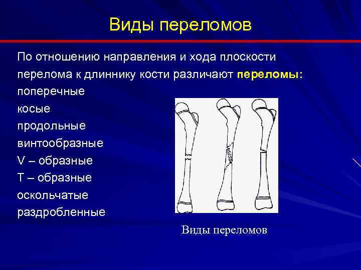 Особенности переломов костей