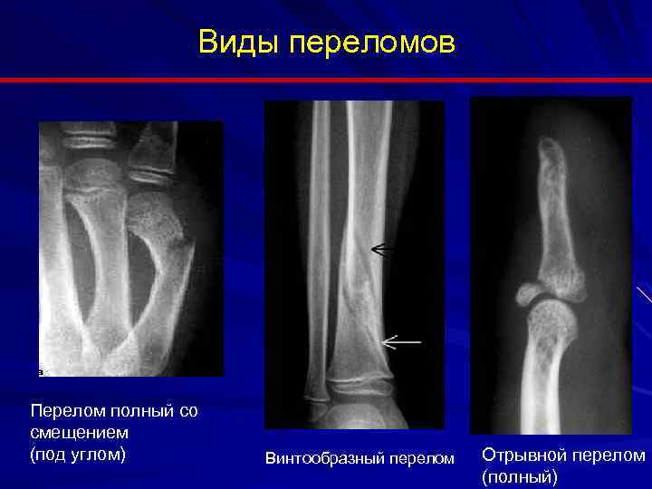 Отрывной перелом