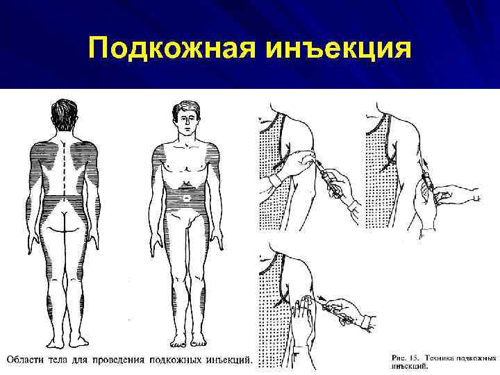 Подкожная инъекция 