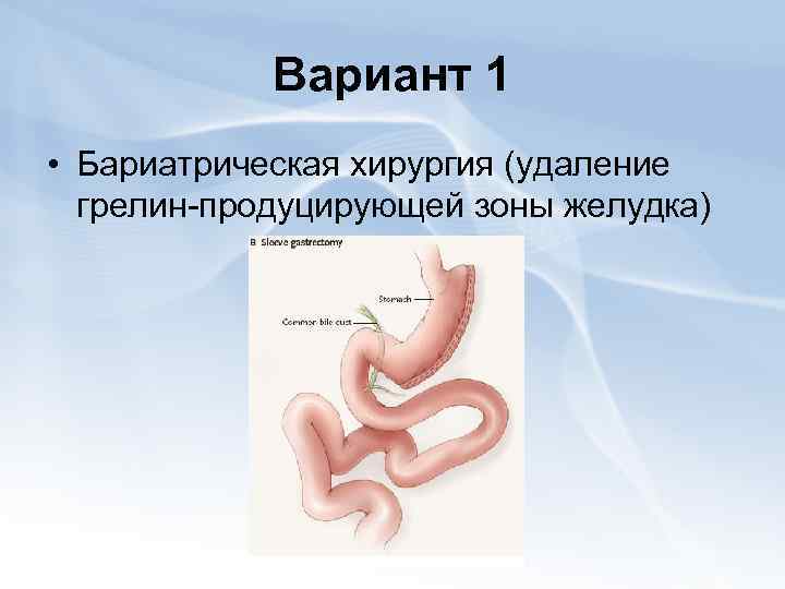 Вариант 1 • Бариатрическая хирургия (удаление грелин-продуцирующей зоны желудка) 