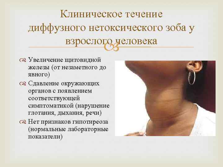Клиническое течение диффузного нетоксического зоба у взрослого человека Увеличение щитовидной железы (от незаметного до