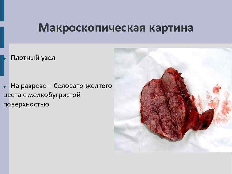 Макроскопическая картина Плотный узел На разрезе – беловато-желтого цвета с мелкобугристой поверхностью 