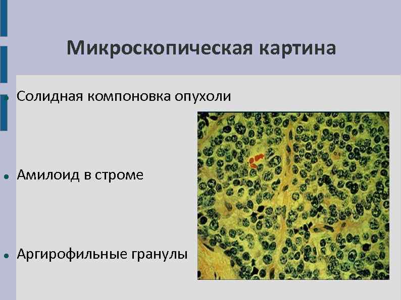 Микроскопическая картина Солидная компоновка опухоли Амилоид в строме Аргирофильные гранулы 