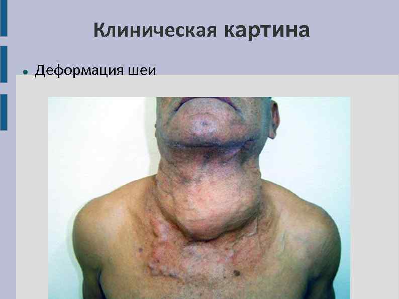 Клиническая картина Деформация шеи 