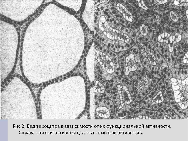Рис 2. Вид тироцитов в зависимости от их функциональной активности. Справа - низкая активность;