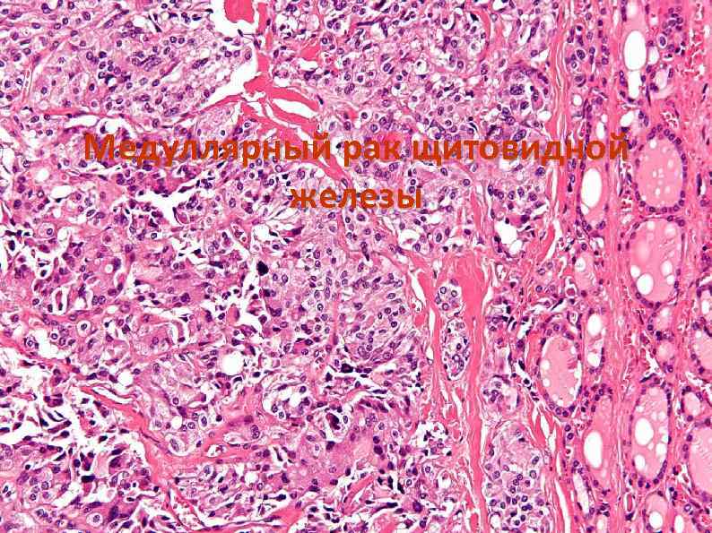 Медуллярный рак щитовидной железы 