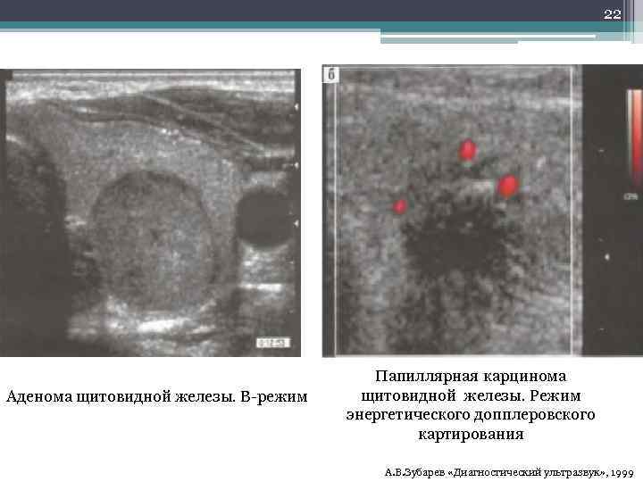 22 Аденома щитовидной железы. В-режим Папиллярная карцинома щитовидной железы. Режим энергетического допплеровского картирования А.