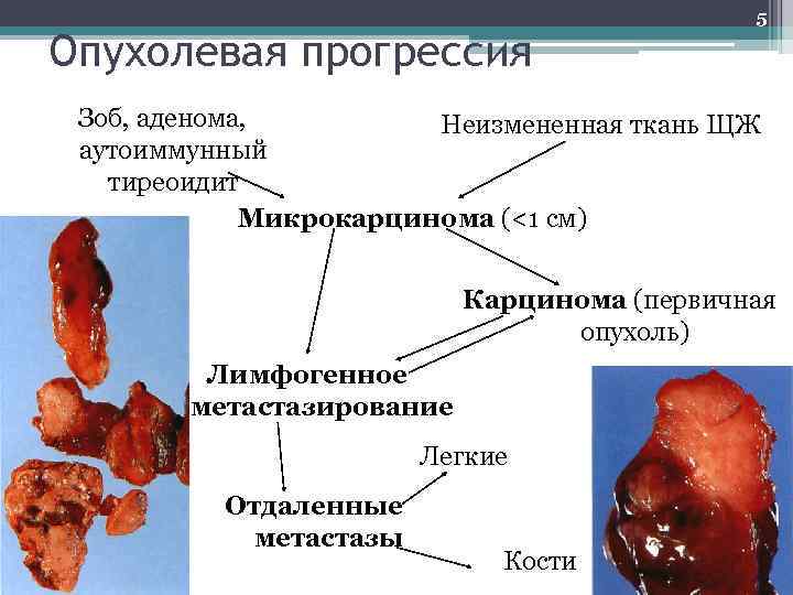 Опухолевая прогрессия 5 Зоб, аденома, Неизмененная ткань ЩЖ аутоиммунный тиреоидит Микрокарцинома (<1 см) Карцинома