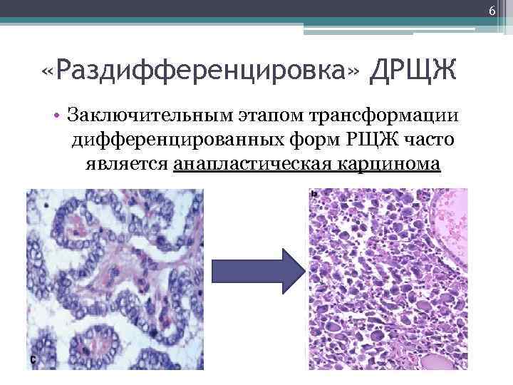 6 «Раздифференцировка» ДРЩЖ • Заключительным этапом трансформации дифференцированных форм РЩЖ часто является анапластическая карцинома