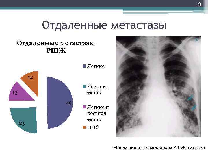 8 Отдаленные метастазы РЩЖ Легкие 12 Костная ткань 13 49 25 Легкие и костная