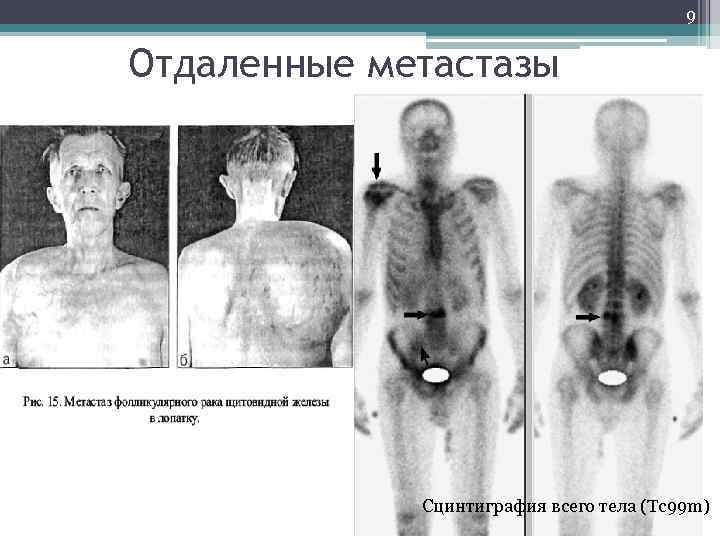 9 Отдаленные метастазы Сцинтиграфия всего тела (Тс99 m) 