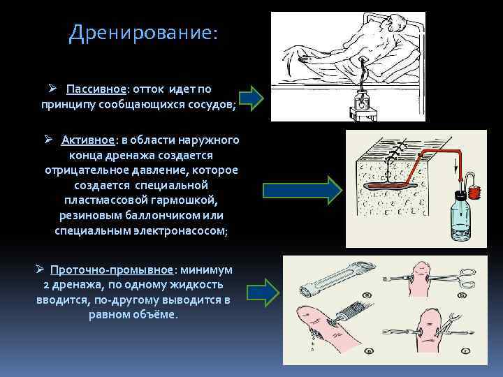 Дренирование: Ø Пассивное: отток идет по принципу сообщающихся сосудов; Ø Активное: в области наружного
