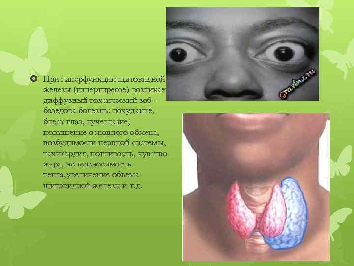  При гиперфункции щитовидной железы (гипертиреозе) возникает диффузный токсический зоб базедова болезнь: похудание, блеск
