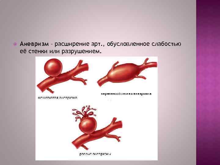  Аневризм – расширение арт. , обусловленное слабостью её стенки или разрушением. 