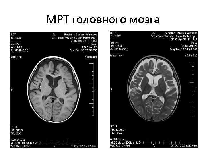 МРТ головного мозга 