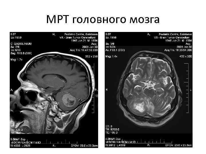 МРТ головного мозга 
