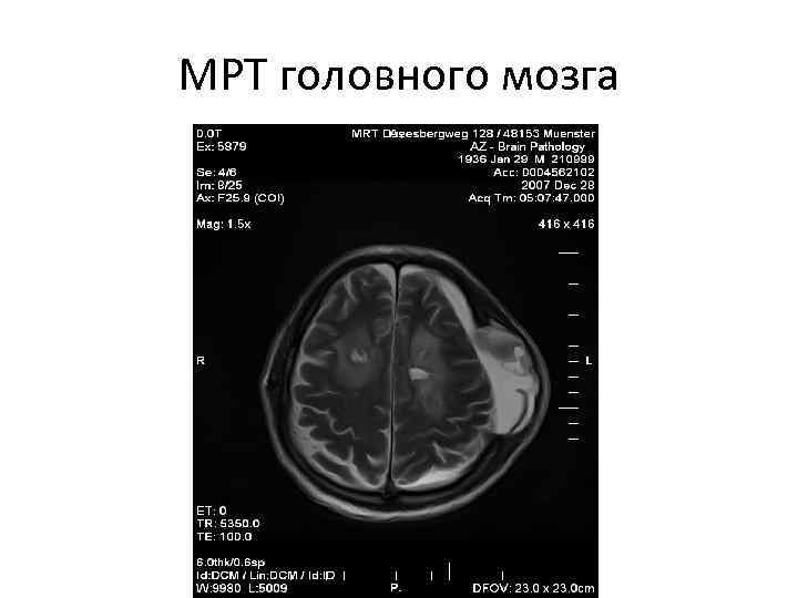 МРТ головного мозга 