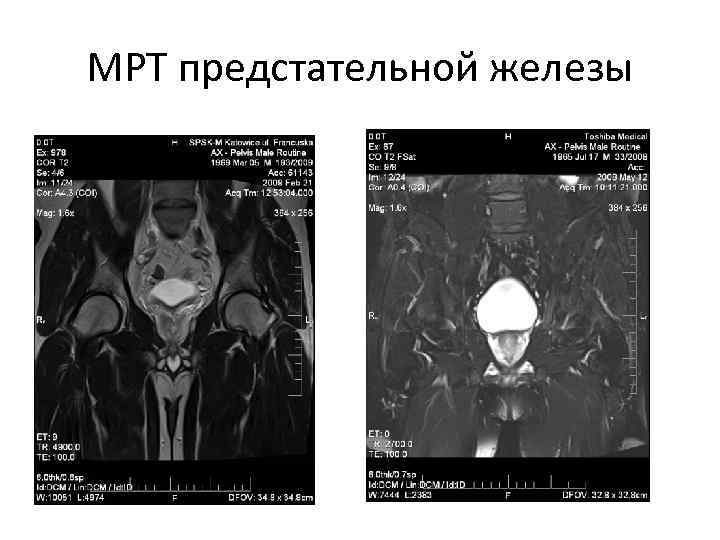 МРТ предстательной железы 