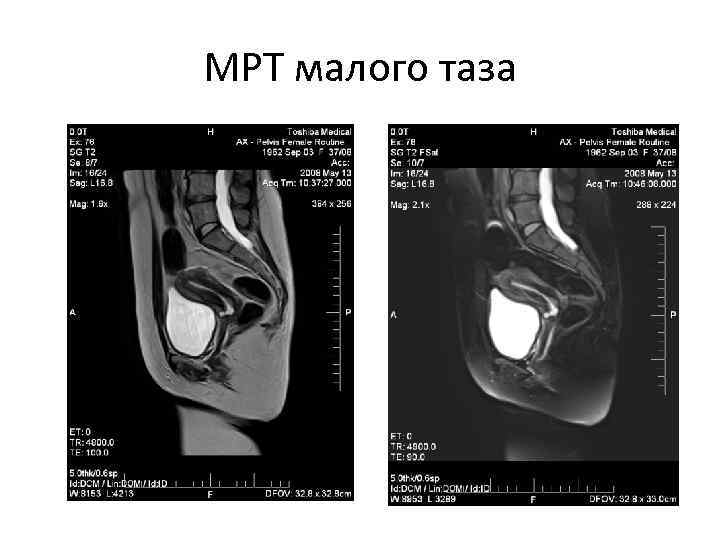 МРТ малого таза 