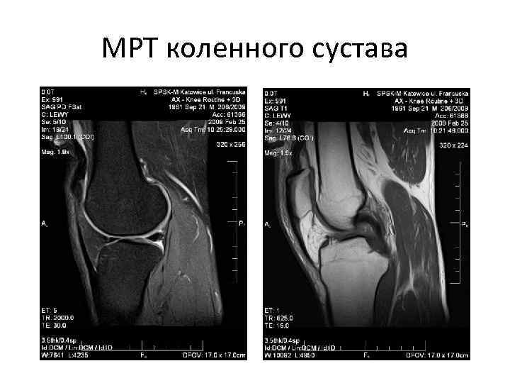 МРТ коленного сустава 