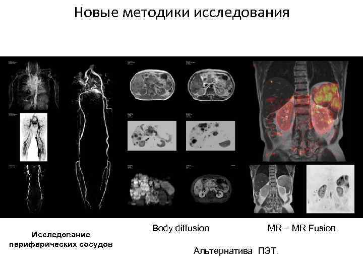Новые методики исследования FBI Исследование периферических сосудов Body diffusion MR – MR Fusion Альтернатива
