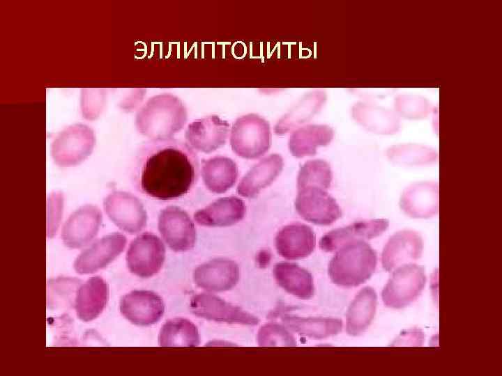 эллиптоциты 
