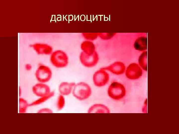 дакриоциты 