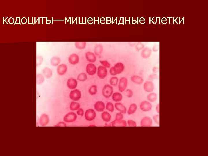 кодоциты—мишеневидные клетки 