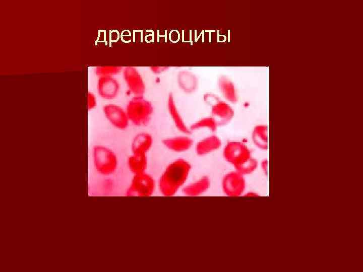 дрепаноциты 