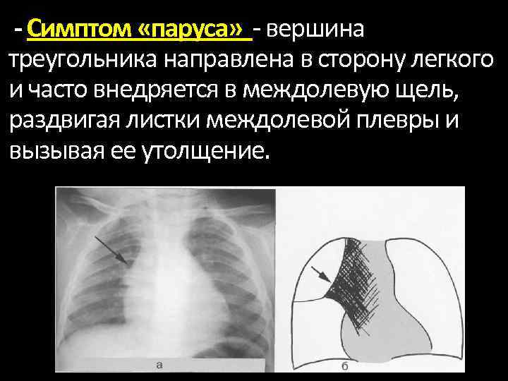 - Симптом «паруса» вершина треугольника направлена в сторону легкого и часто внедряется в междолевую