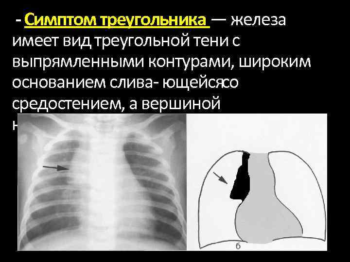 - Симптом треугольника — железа имеет вид треугольной тени с выпрямленными контурами, широким основанием